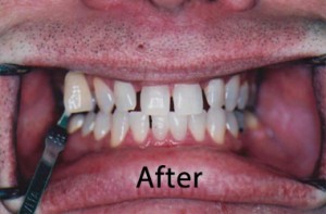 Teeth Whitening Near Me cockeysville md