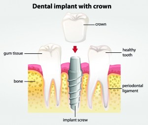 Dental Implants