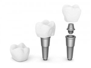 Implant Crowns in Timonium1
