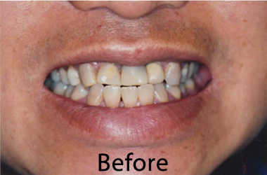 dental veneers cockeysville maryland Dental Veneers Near Me