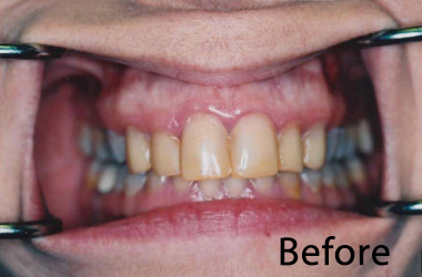 Dental Veneers Near Me2