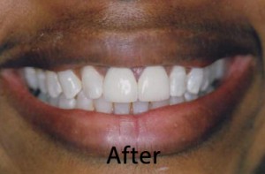 Hunt Valley Veneers, Cockeysville Dental Veneers