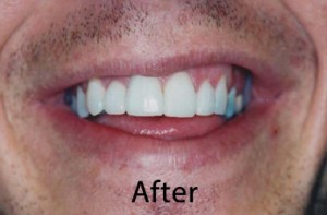 Hunt Valley Veneers, Cockeysville Dental Veneers