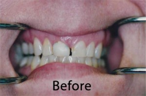 Hunt Valley Veneers, Cockeysville Dental Veneers