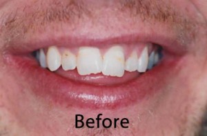 Hunt Valley Veneers, Cockeysville Dental Veneers